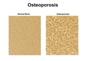 osteoporosis (1)