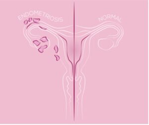 Comparison of endometriosis versus healthy vagina.