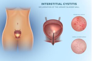 Understanding interstitial cystitis - cartoon image depicting inflamed bladder.