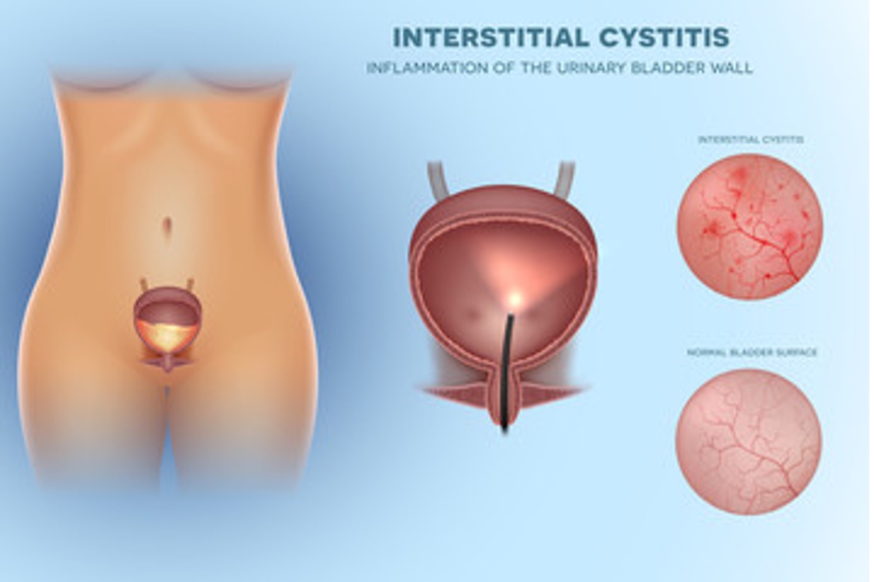 Identifying Interstitial Cystitis Seattle Clinical Research Center