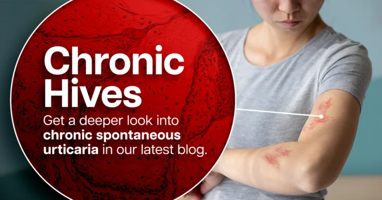 Chronic Hives